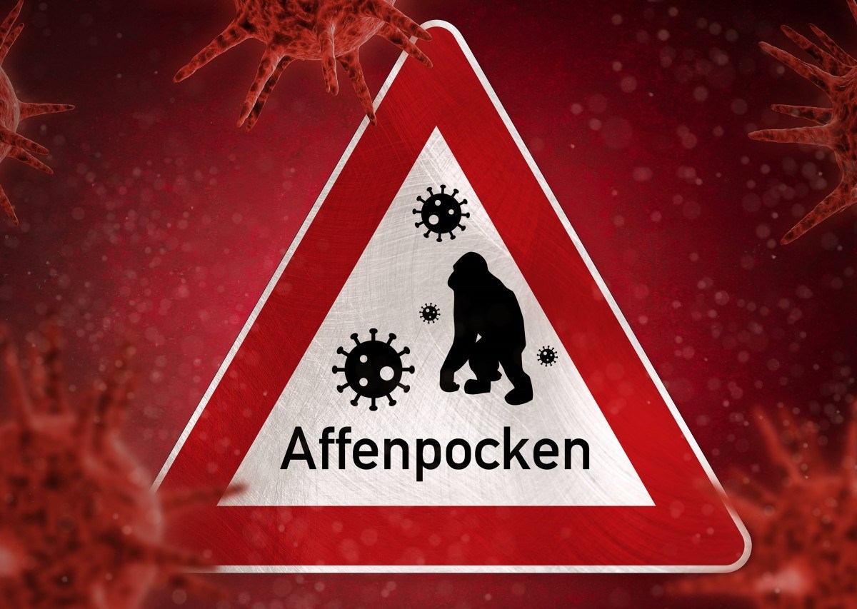 Verdacht auf Affenpocken in NRW! (Symbolfoto)