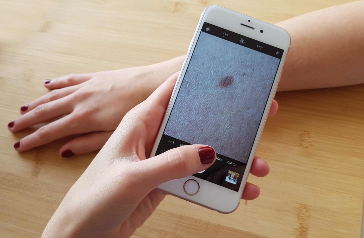Für die Diagnose per App müssen zwei Fotos der betroffenen Hautstelle aufgenommen, sowie einige Fragen zu möglichen Symptomen beantwortet werden. 
