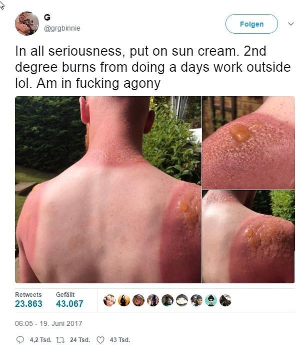 g-auf-twitter_-_in-all-seriousness-put-on-sun-cream.-2nd-degree-burns-from-doin_2017-06-22_14-32-28~2d497018-2d1a-42ee-bbba-ae331b7195c5.jpg